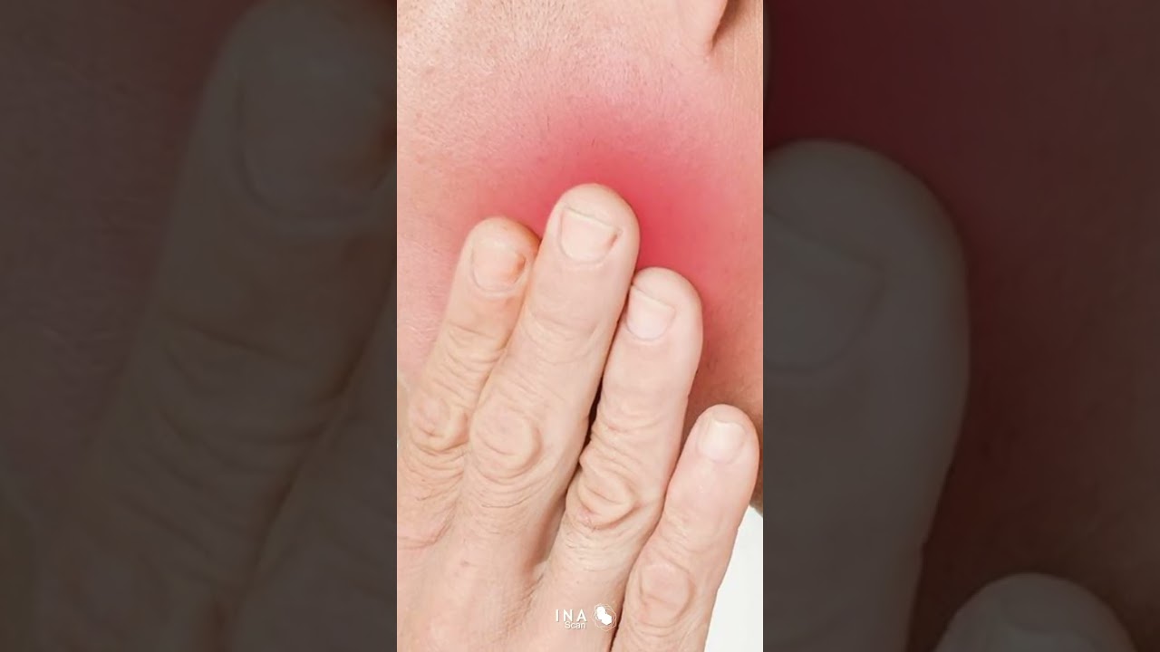 inflamación de las glándulas parótidas codycross