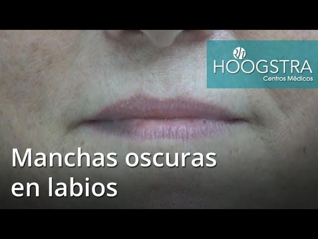 mancha oscura en el labio inferior