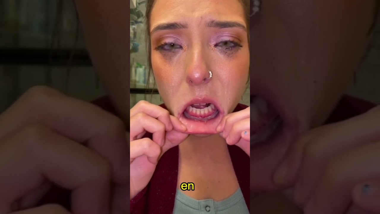 manchas blancas en los labios odontología