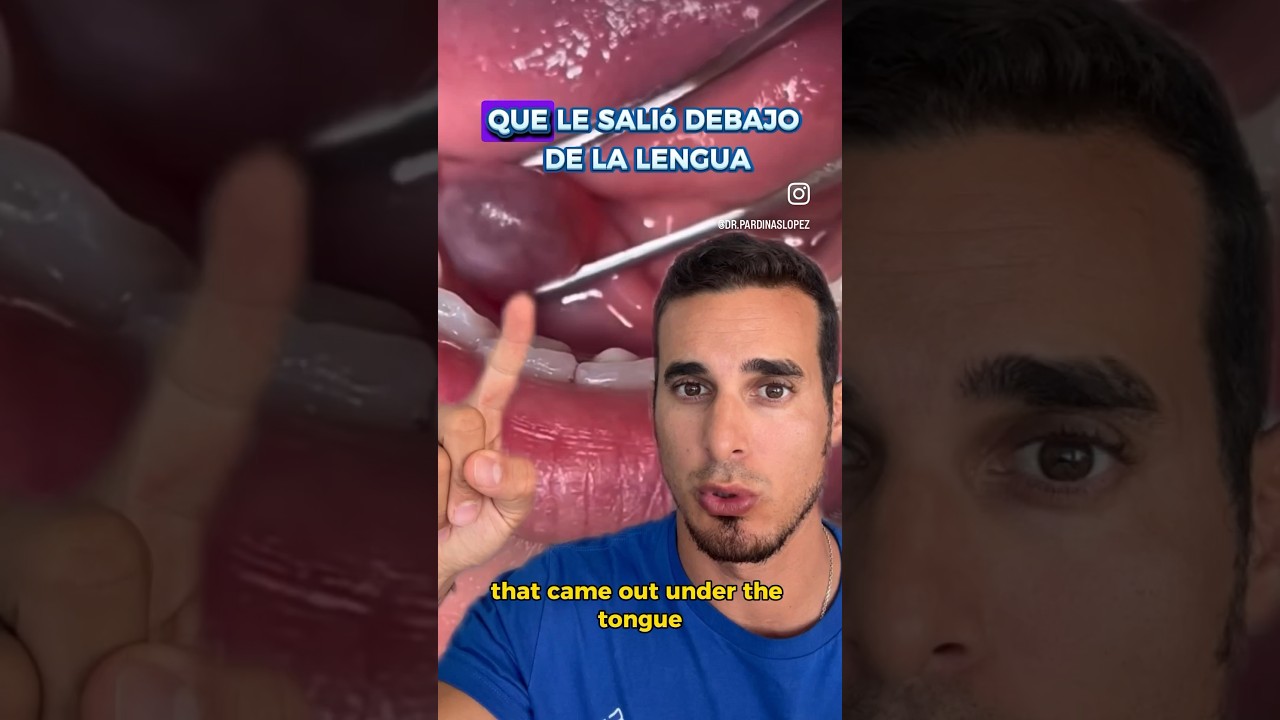 me salio una ampolla debajo de la lengua