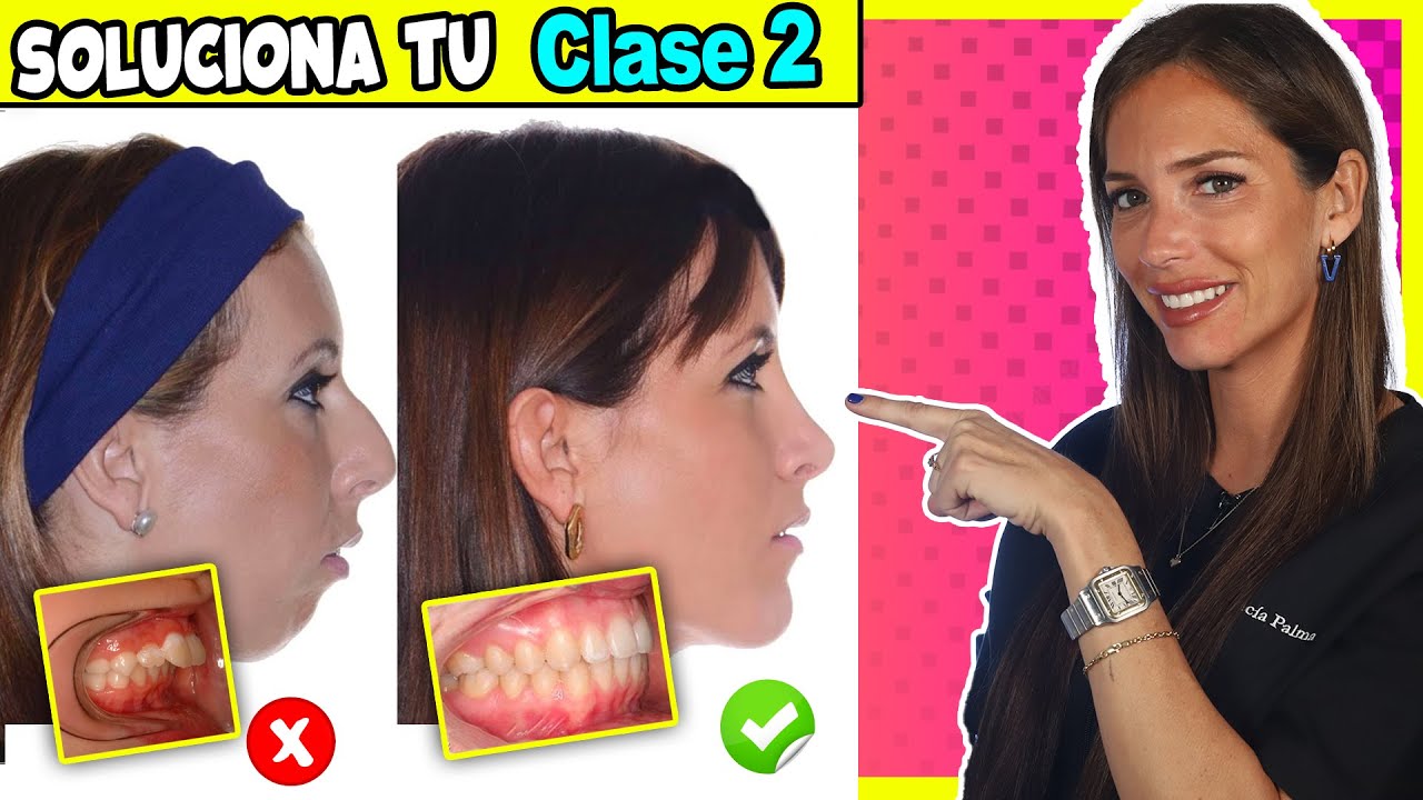 mordida clase 2 antes y después
