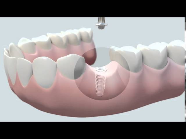 pasos para poner un implante dental