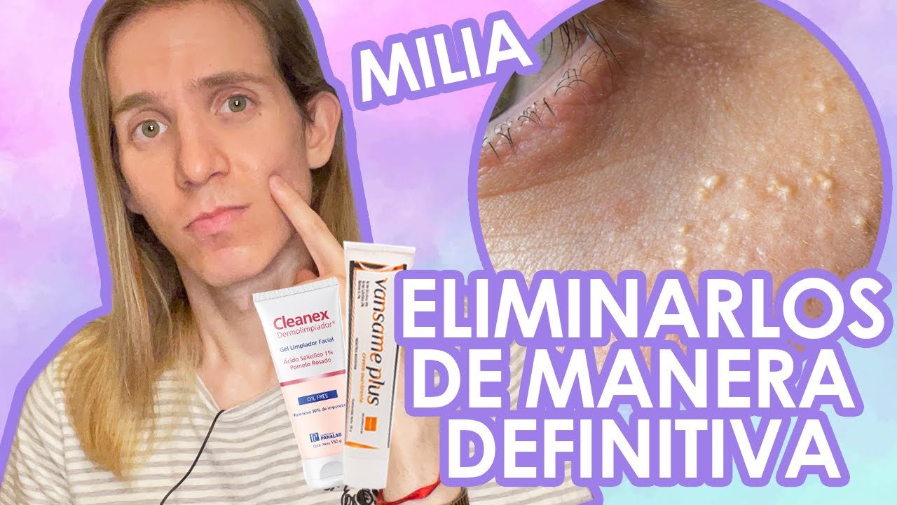 puntos blancos en la cara como eliminarlos