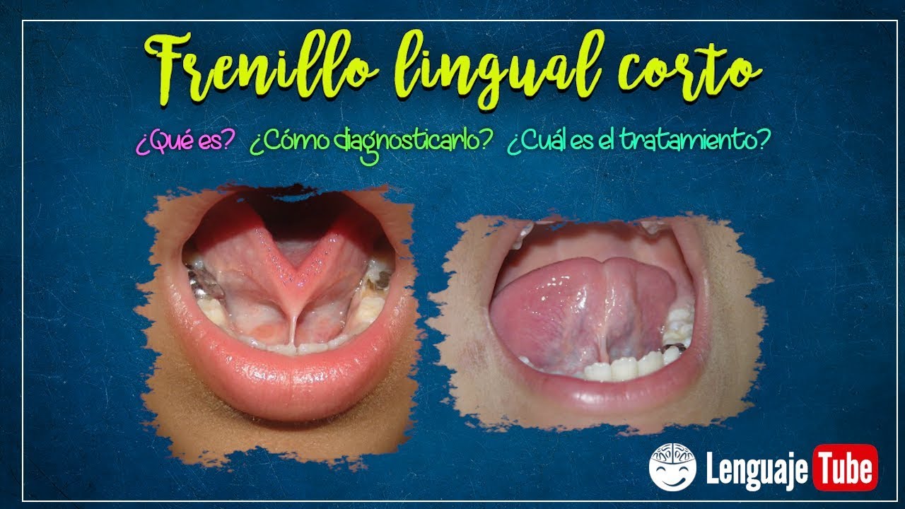 que es el frenillo de la lengua