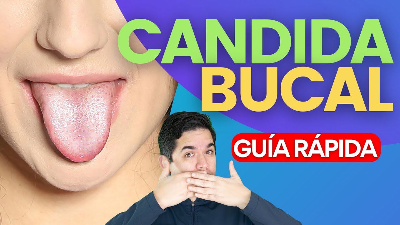 que es la candidiasis en la lengua
