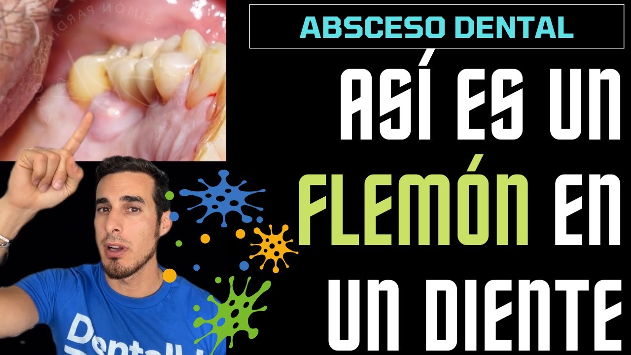 que es un flemon en la boca