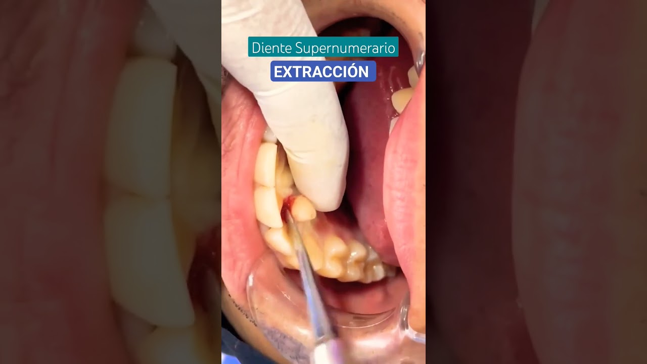 sacar muela de urgencia seguridad social