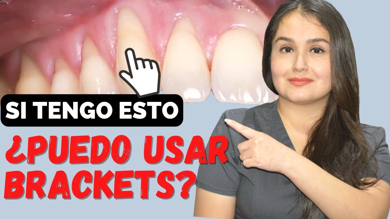 se puede poner ortodoncia con encías retraídas