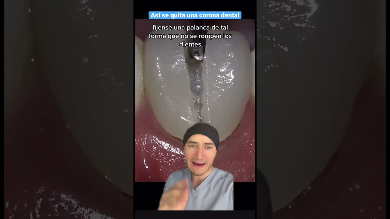 se puede quitar una funda dental