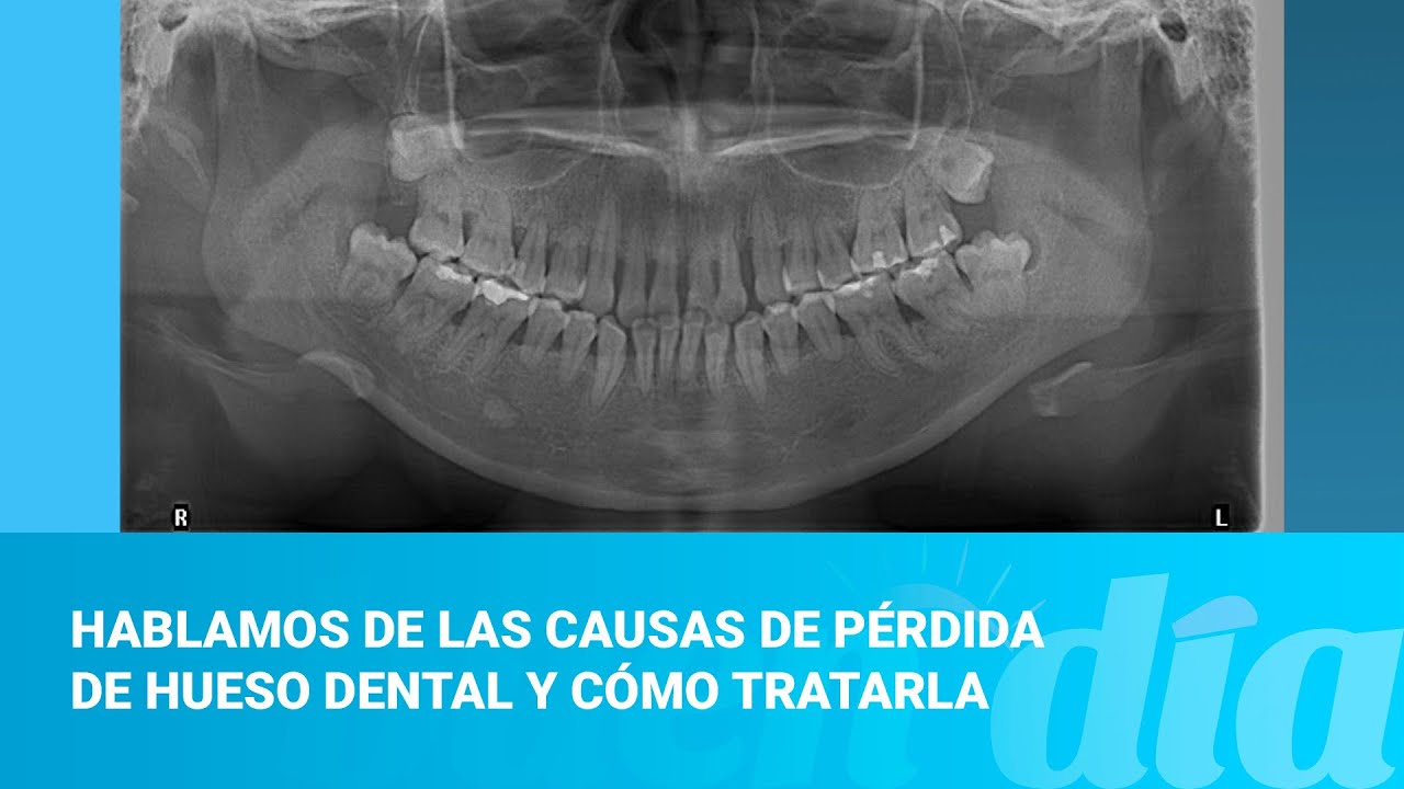 sintomas de perdida de hueso dental