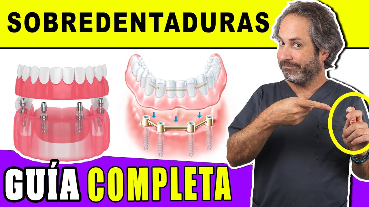 sobredentadura con barra sobre 4 implantes