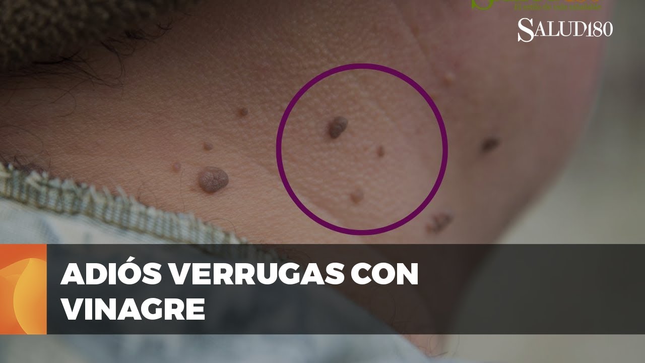 vinagre de manzana para las verrugas