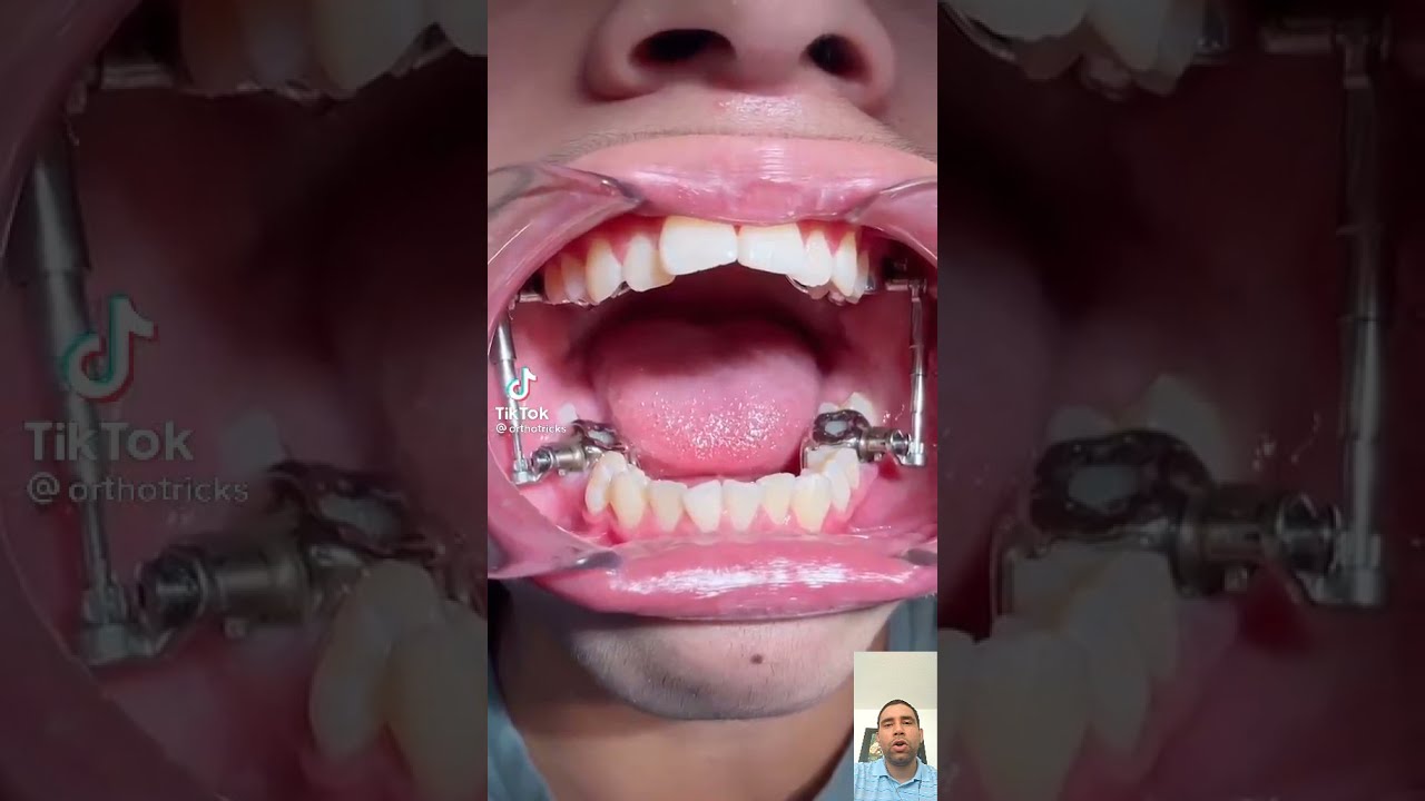 aparato dental para corregir mandíbula adulto