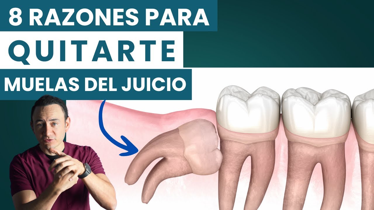 beneficios de quitar las muelas del juicio