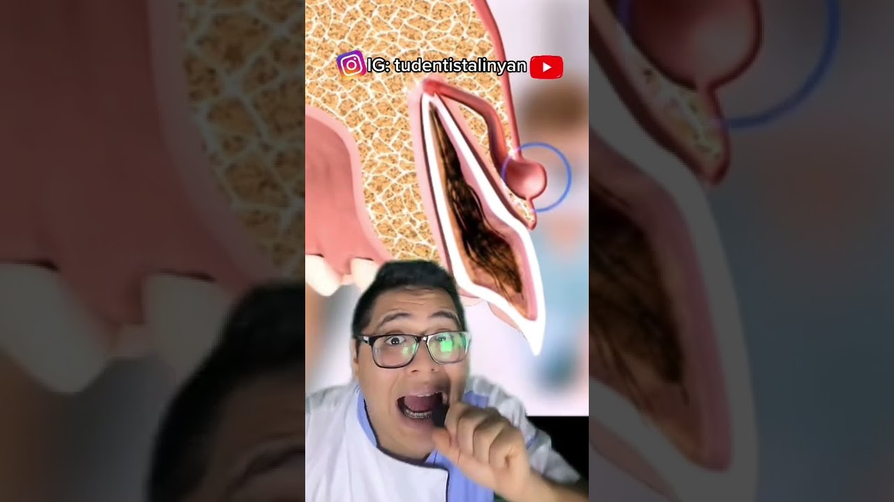 como bajar un flemón en 24 horas