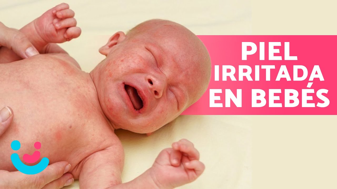 como quitar el sarpullido en bebés