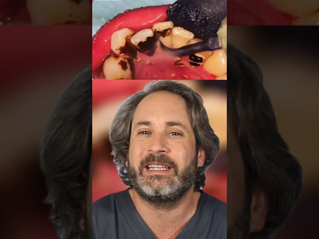 como quitar el sarro negro de los dientes