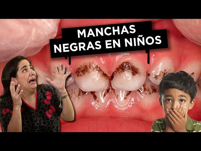 como quitar las manchas negras de los dientes