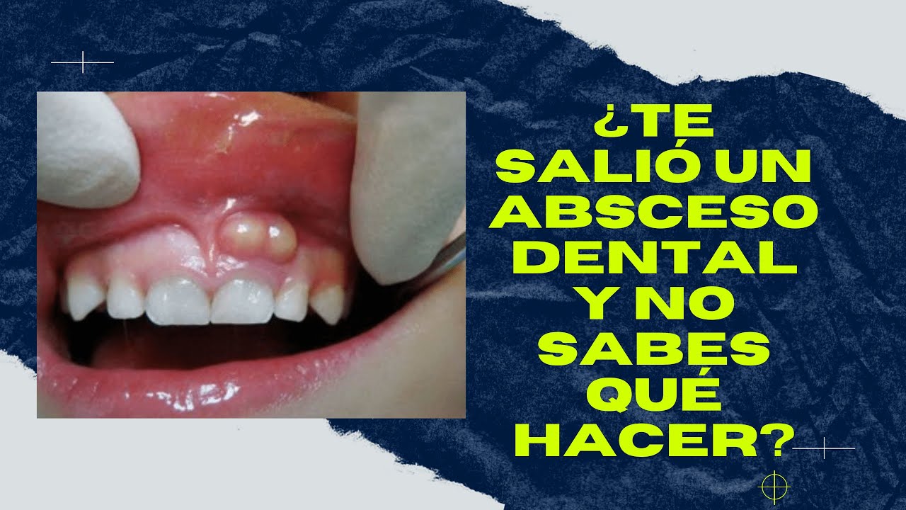 como quitar un flemon de la encia