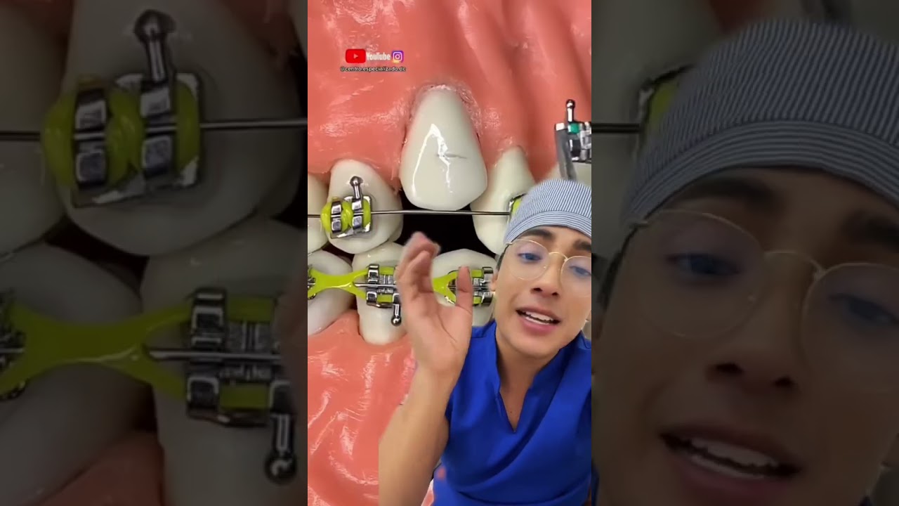 como se escribe brackets de dientes