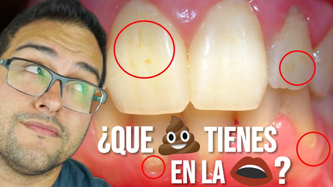 como se llama la placa de los dientes