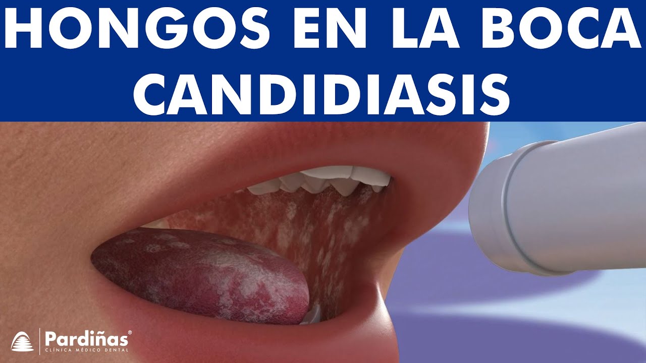 como son los hongos en la boca