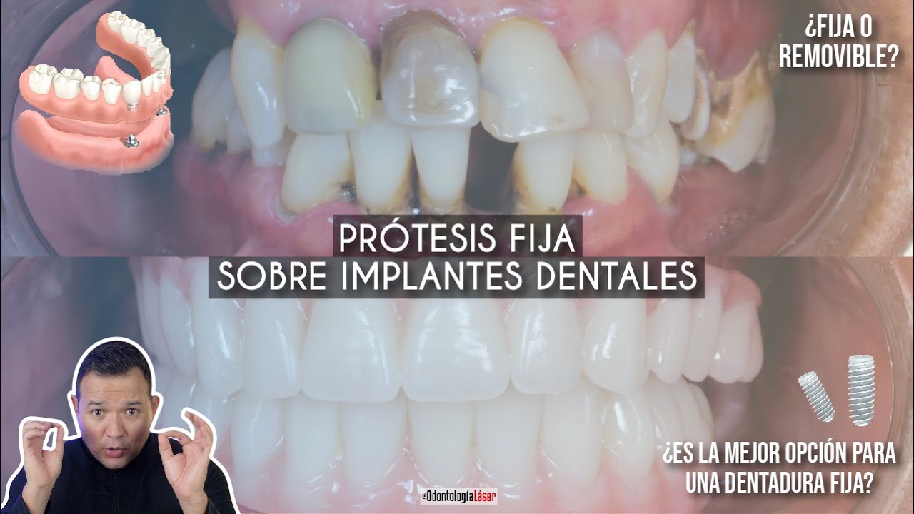 cuanto cuesta ponerse la boca entera