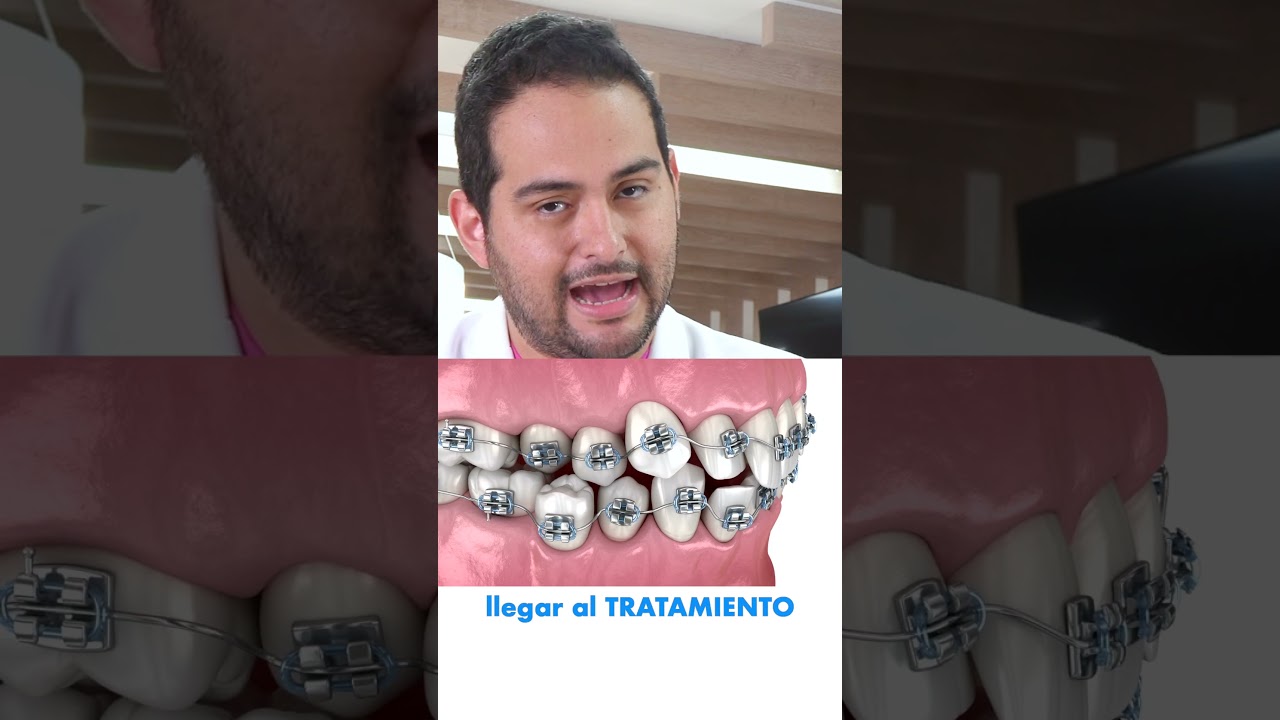cuanto tardan en ponerte los brackets despues del estudio