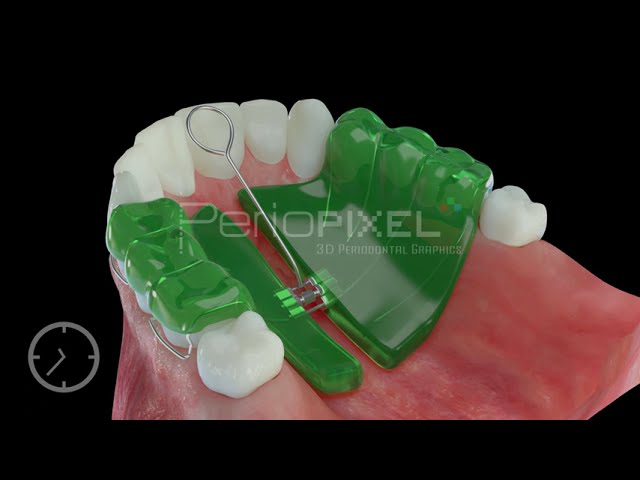 expansor de paladar para niños precio