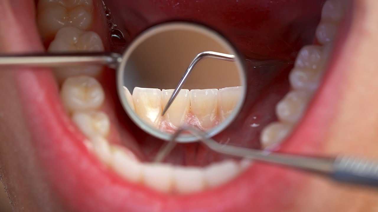 how many adult teeth do you get