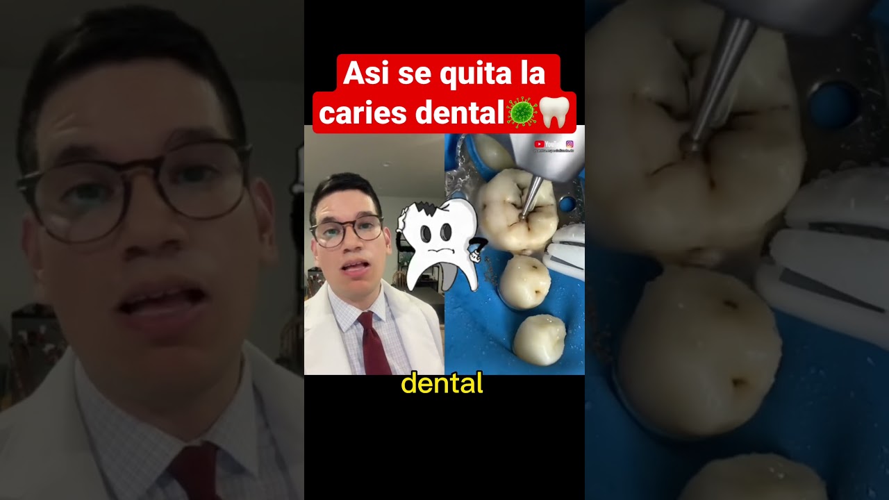 limpieza de caries en los dientes