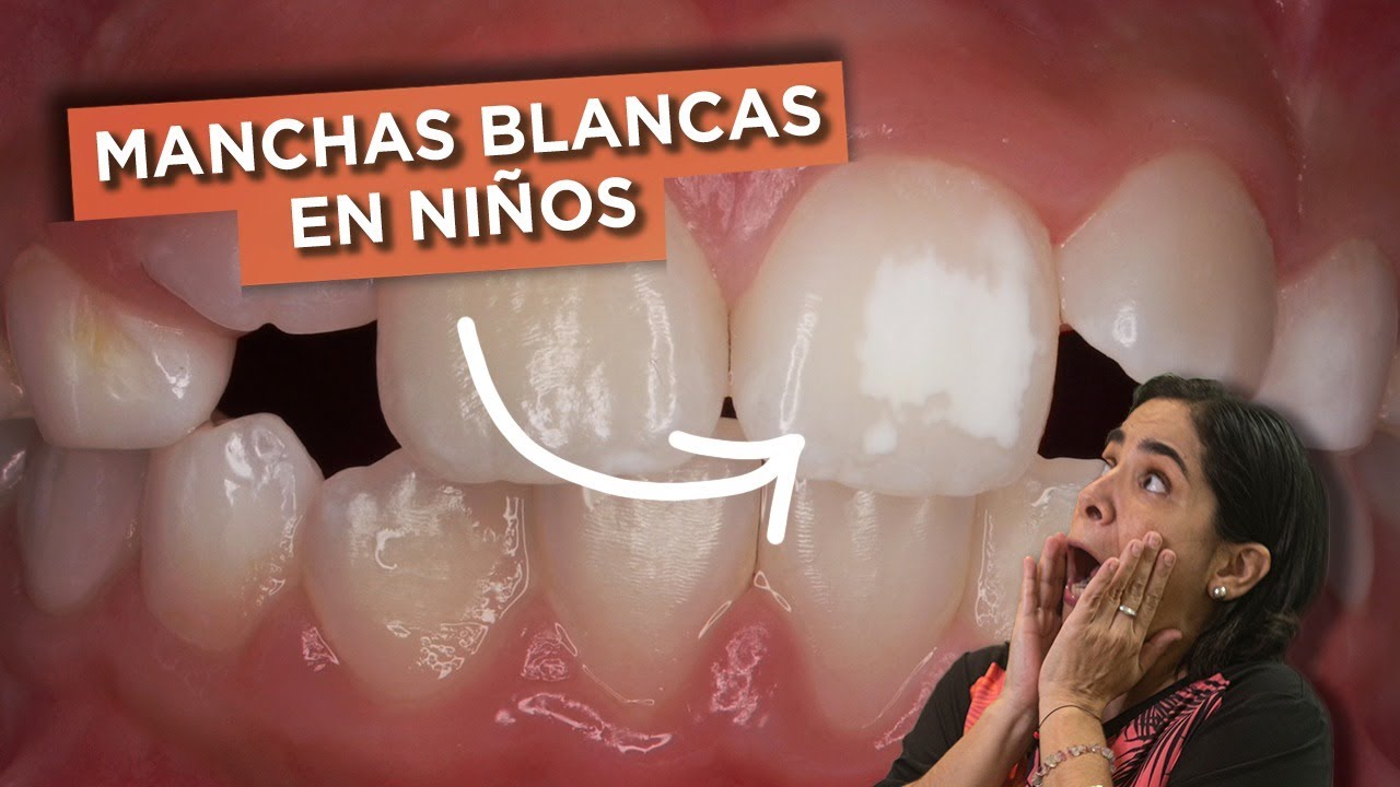 manchas blancas dientes niños 7 años