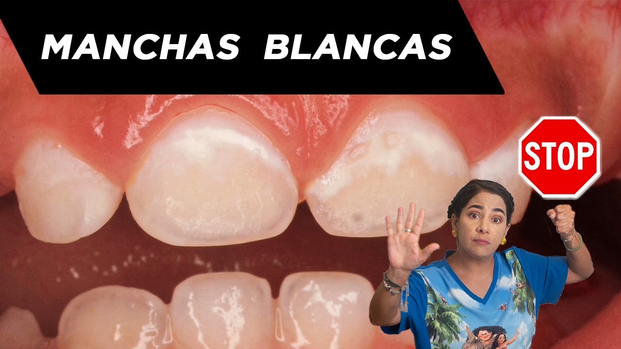 manchas blancas en los dientes del bebe