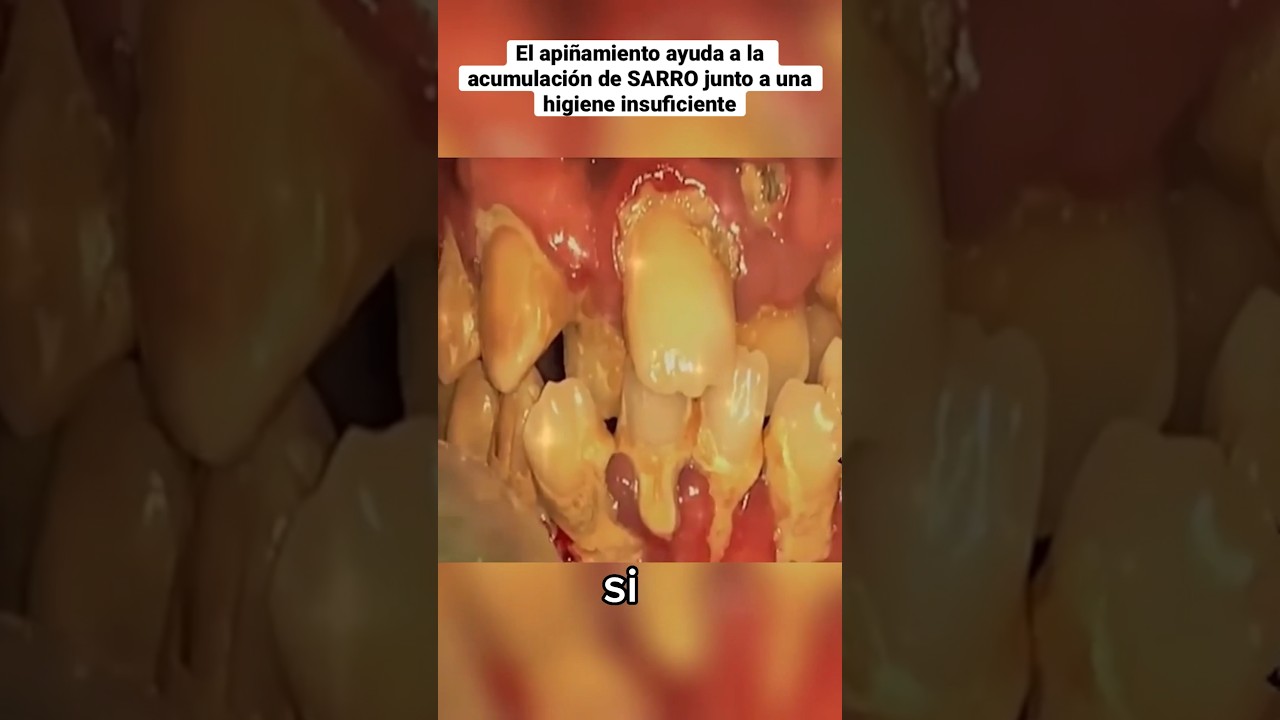 periodontitis limpieza dental antes y despues