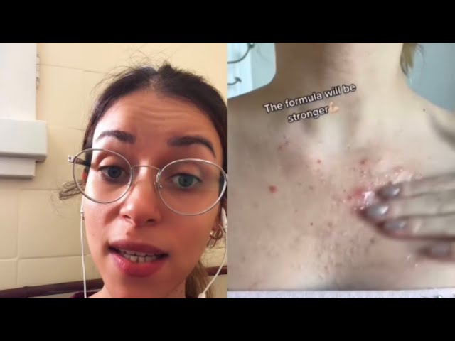 porque salen granos en los senos