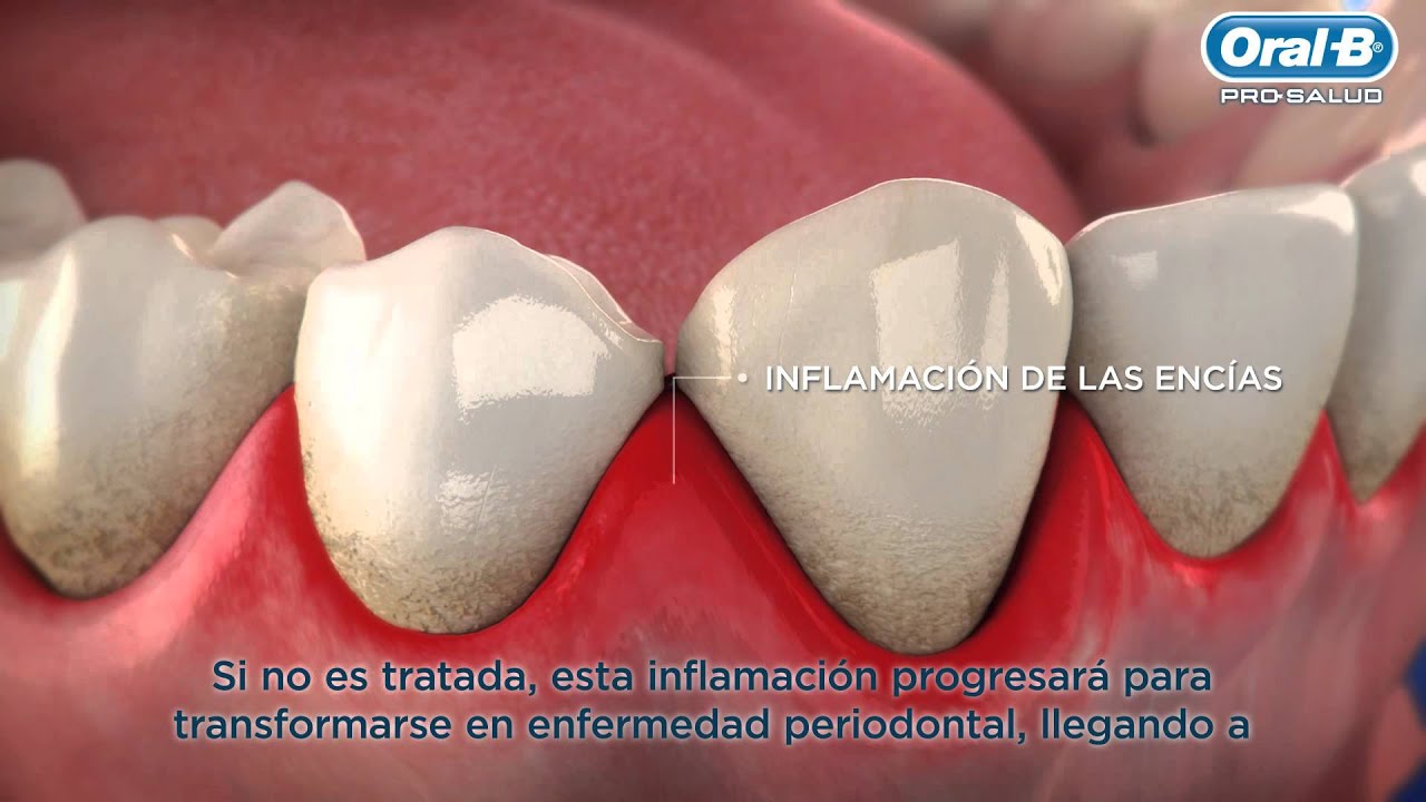 que es gingivitis en la boca