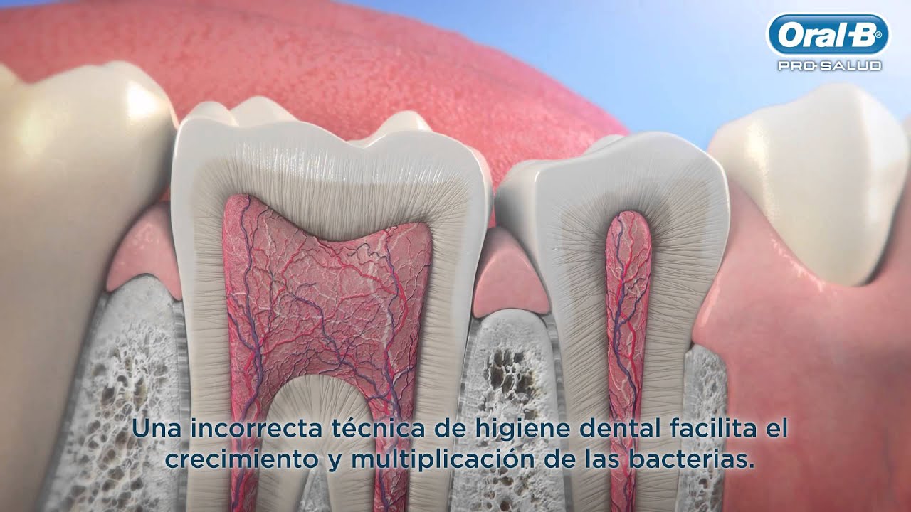 que es una caries y que la produce