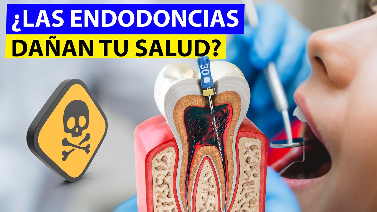 que pasa cuando un tratamiento de conducto se infecta