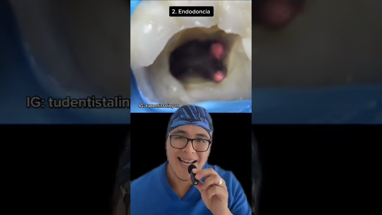 que pasa si se te cae una muela picada