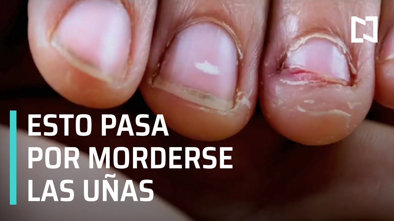 que pasa si te muerdes las uñas