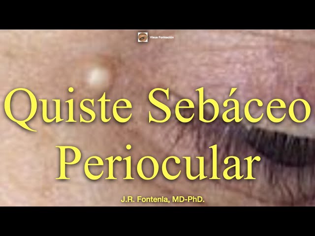 quiste de grasa en el ojo