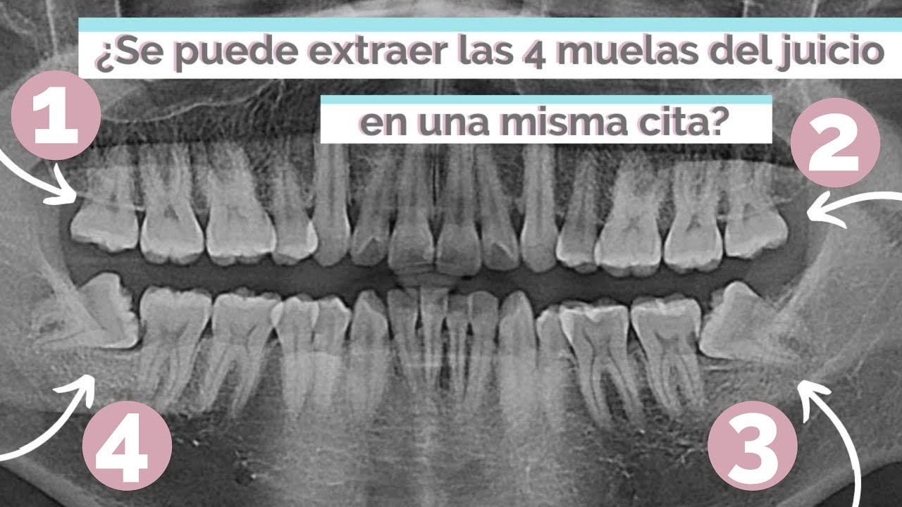 quitar 2 o 4 muelas del juicio