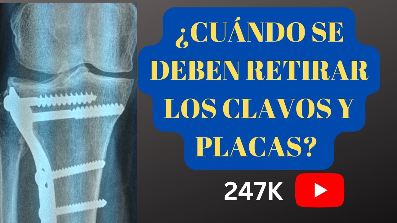 rechazo de placas y tornillos síntomas