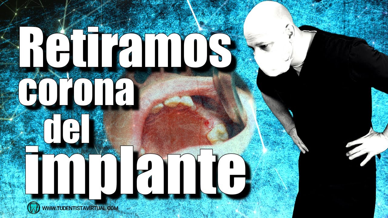 se puede quitar una corona dental y volver a poner