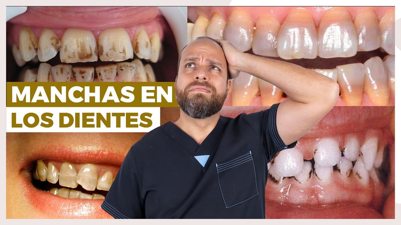 tipos de manchas en los dientes
