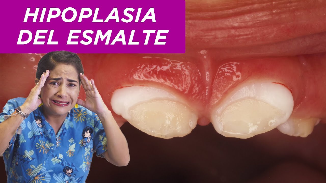 tratamiento para la hipoplasia dental en niños