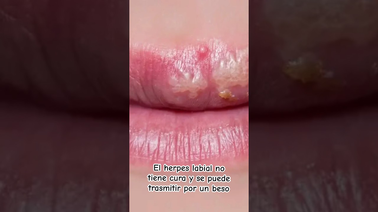ampolla en el labio por dentro