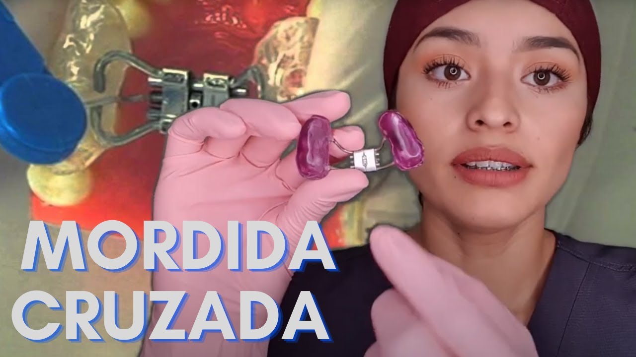 aparato para corregir la mordida cruzada