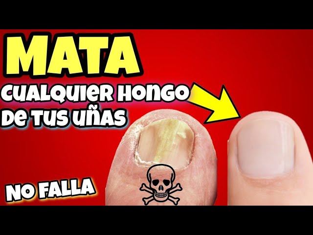 bicarbonato y agua oxigenada para las uñas