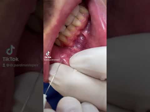bulto en el labio por dentro